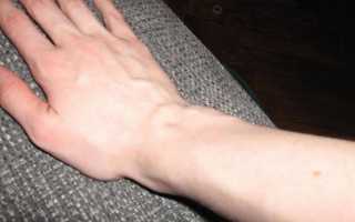 Симптомы и лечение варикозного расширения вен на руках