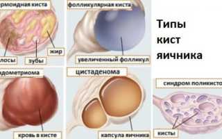 Особенности процедуры и послеоперационный период после лапароскопии кисты яичника
