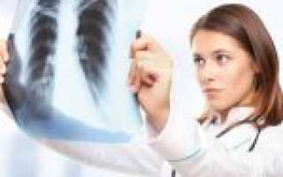 Тромбоэмболия лёгочной артерии — симптомы, лечение, последствия