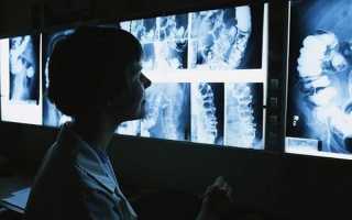 Рентген шейного отдела позвоночника в двух проекциях как делают