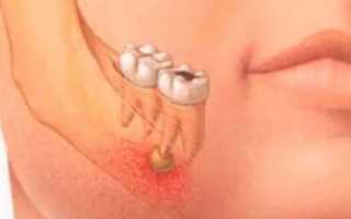 Гранулема зуба — что это такое, и как ее вылечить